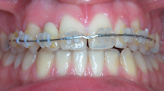 traitement en orthodontie la garenne colombes