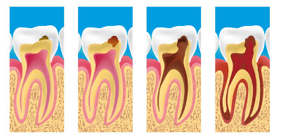 caries dentiste la garenne colombes