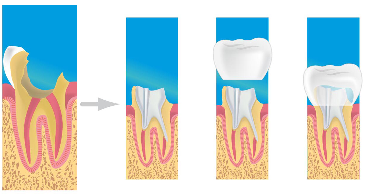 Qu'est-ce qu'une restauration dentaire ?