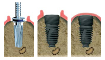 les implants dentaires posés chez votre dentiste à la garenne colombes