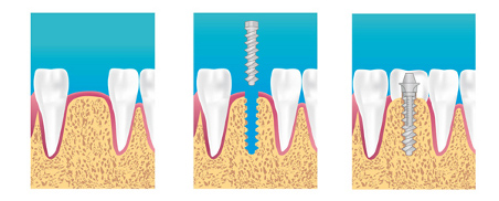 implant dentaire la garenne colombes